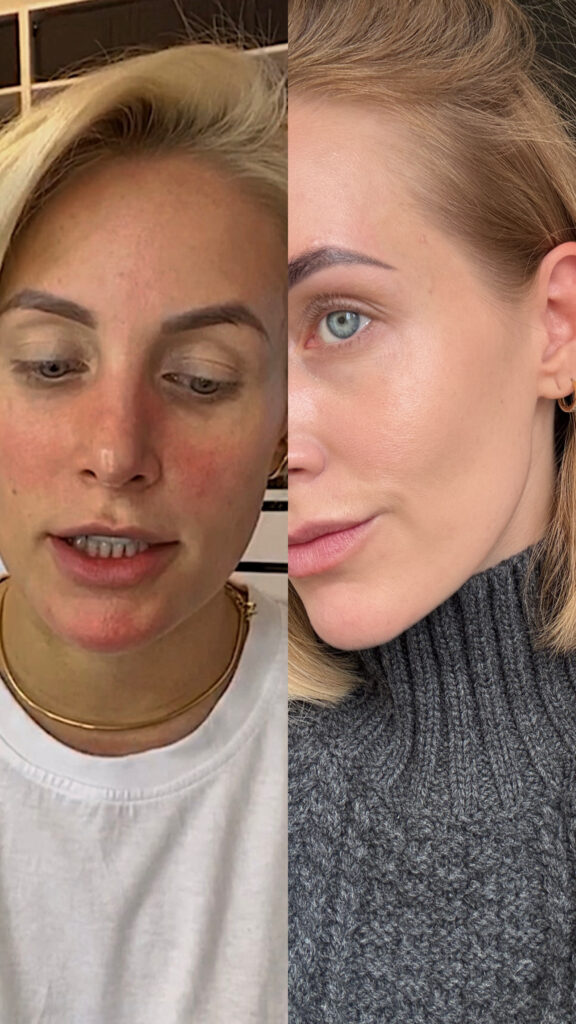 Rosacea vorher nacher